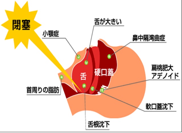 沈下性肺炎