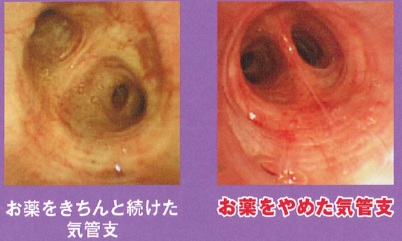 お薬をきちんと続けた気管支とお薬をやめた気管支の比較写真